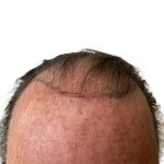 Hair Transplants Before & After Patient #1338