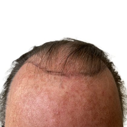 Hair Transplants Before & After Patient #1338