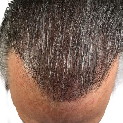 Hair Transplants Before & After Patient #1338