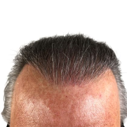 Hair Transplants Before & After Patient #1338