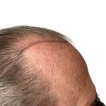 Hair Transplants Before & After Patient #1338