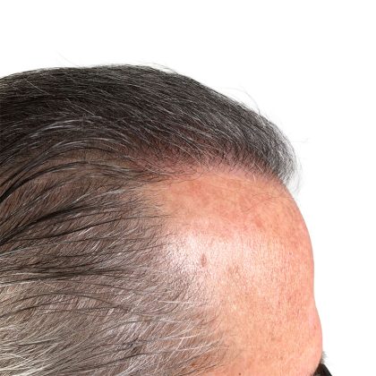 Hair Transplants Before & After Patient #1338