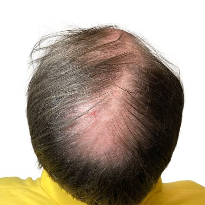 Hair Transplants Before & After Patient #1338