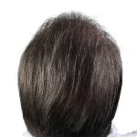 Hair Transplants Before & After Patient #1338