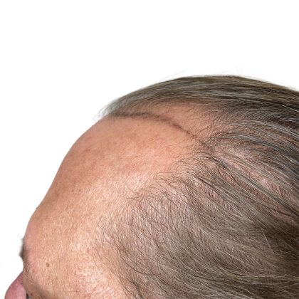 Hair Transplants Before & After Patient #1338
