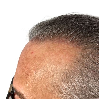 Hair Transplants Before & After Patient #1338