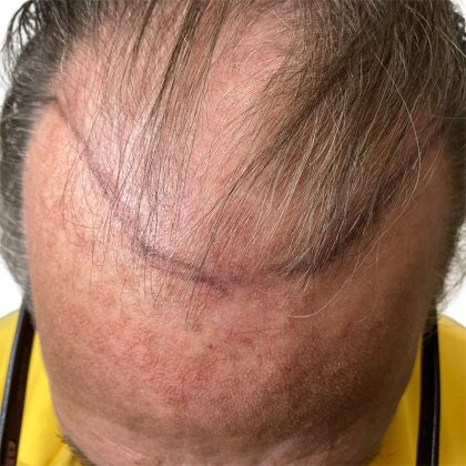 Hair Transplants Before & After Patient #1338