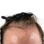 Hair Transplants Before & After Patient #1339
