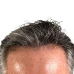 Hair Transplants Before & After Patient #1339