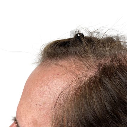 Hair Transplants Before & After Patient #1339