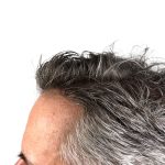 Hair Transplants Before & After Patient #1339