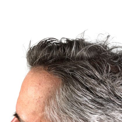 Hair Transplants Before & After Patient #1339