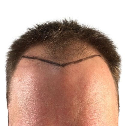 Hair Transplants Before & After Patient #1340