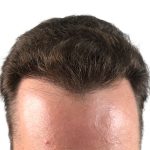 Hair Transplants Before & After Patient #1340