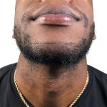 Beard Transplant Before & After Patient #1151