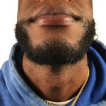 Beard Transplant Before & After Patient #1151