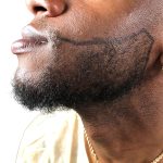 Beard Transplant Before & After Patient #1151