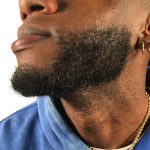 Beard Transplant Before & After Patient #1151