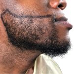 Beard Transplant Before & After Patient #1151