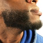 Beard Transplant Before & After Patient #1151